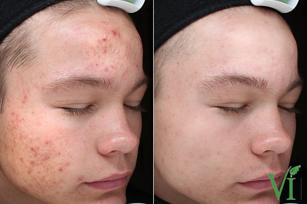 Acne