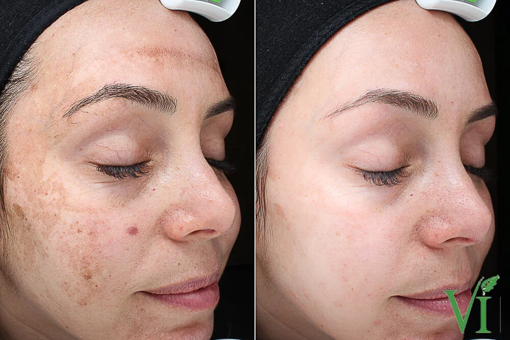 Melasma