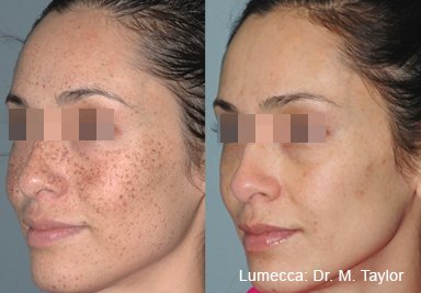 lumecca-before-after-dr-m-taylor-preview-1.jpg