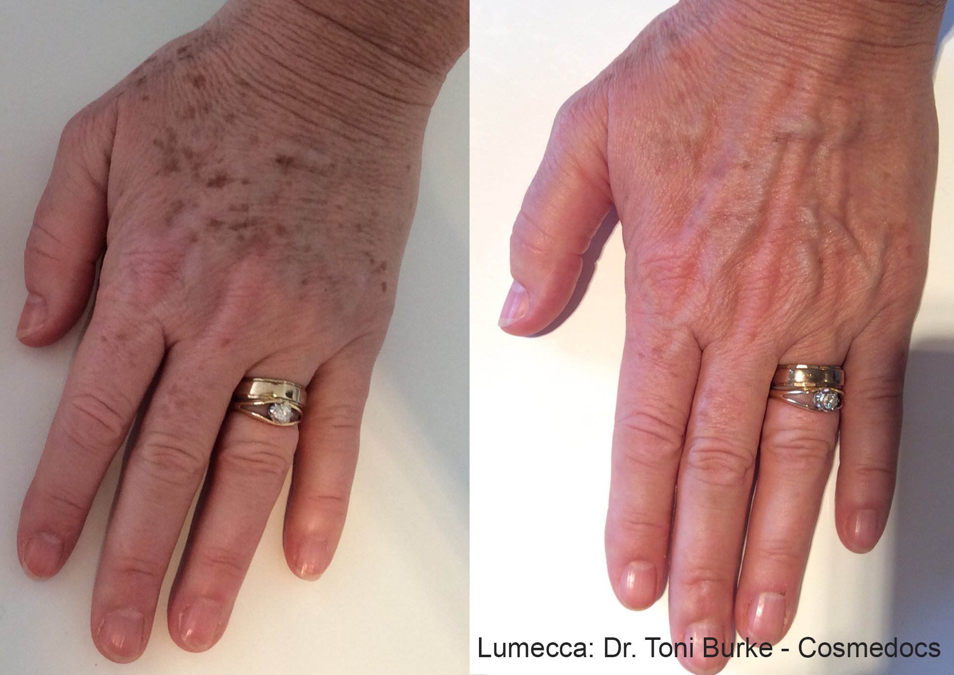 lumecca-before-after-dr-toni-burke-cosmedocs-preview-1.jpg