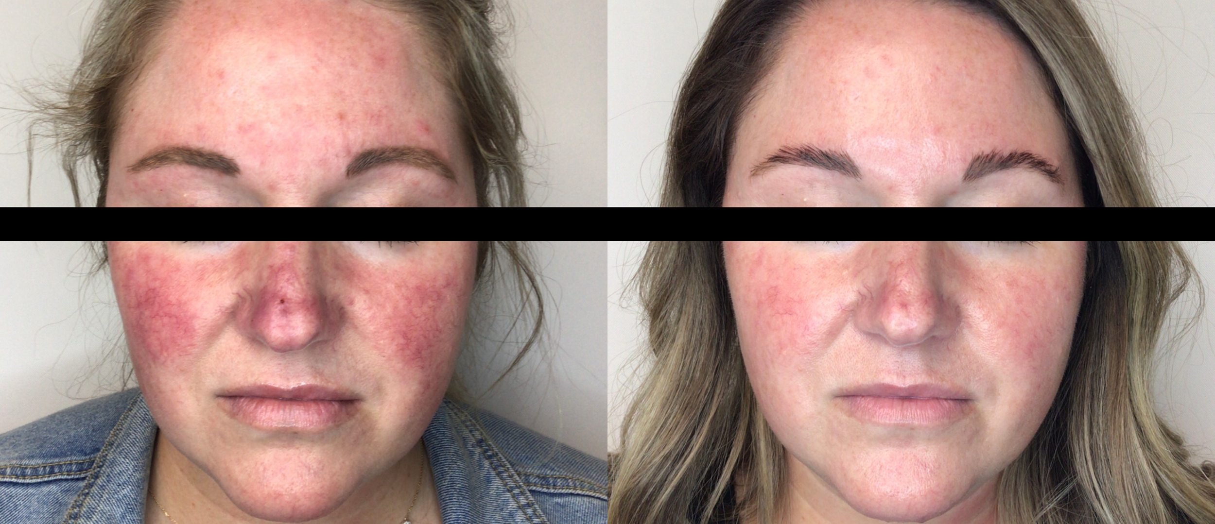 lumecca-before-after-spry-skin-and-wellness-preview-2.png