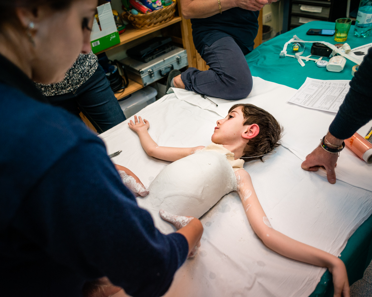 "When he was younger, Simone didn’t accept so easily plaster casts used to realize specifically shaped braces for him, but growing up, it has become natural"