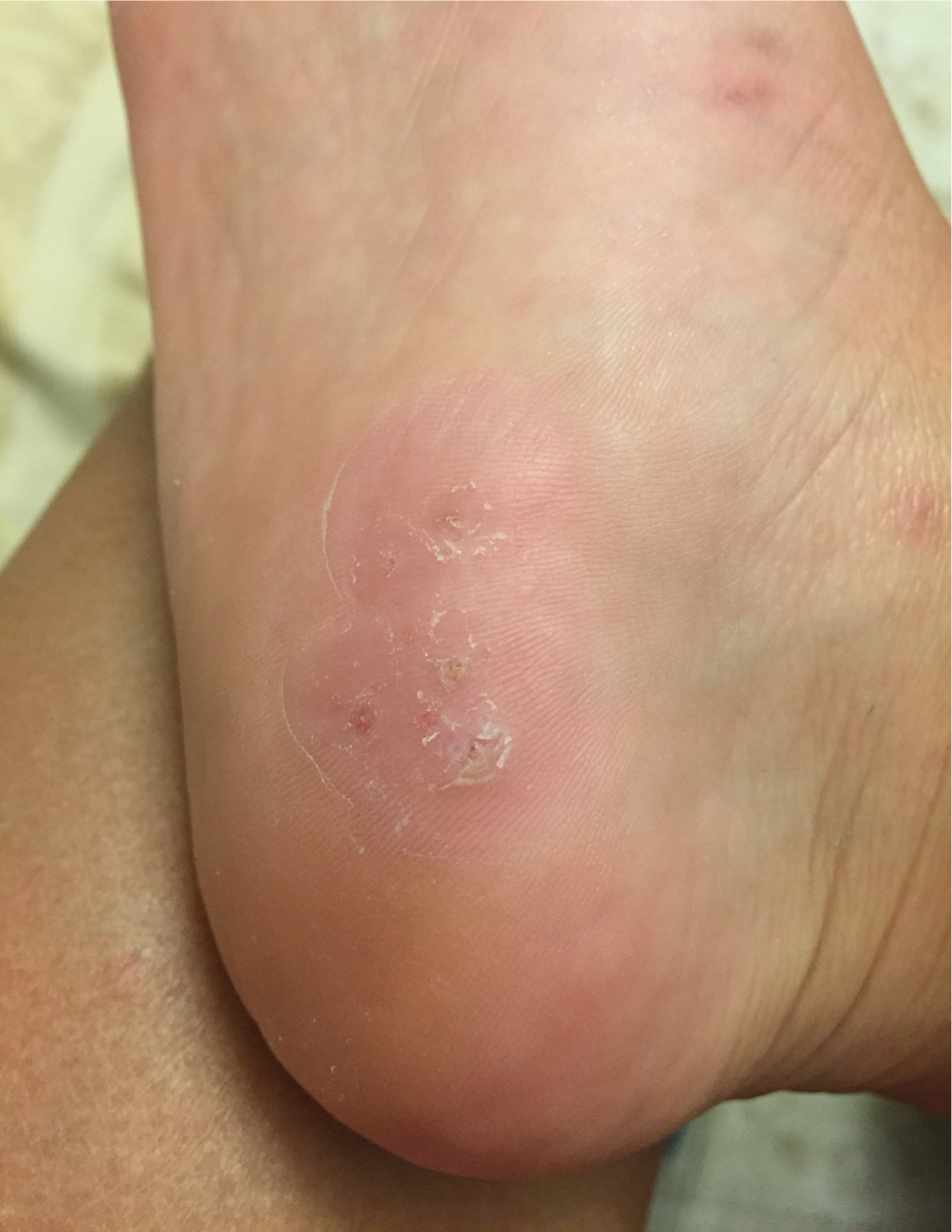 wart on foot or blister)
