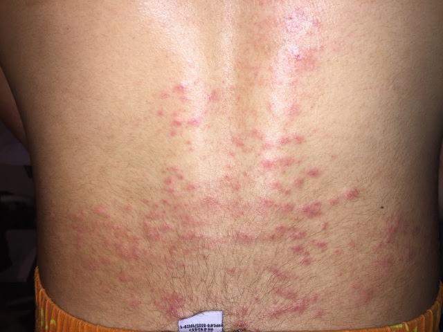 His lower back before .