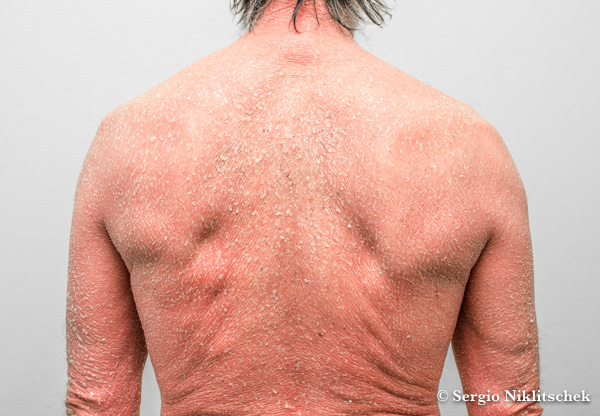 Psoriasis Eritrodérmica | Psoriasis Severa