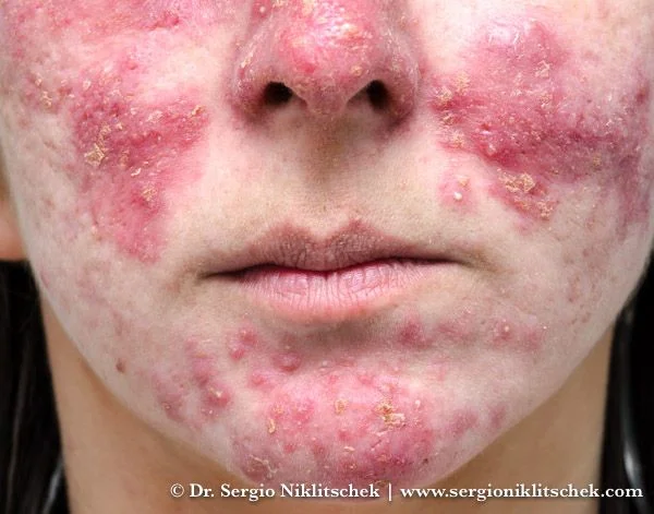 Rosacea