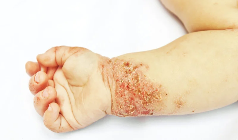 Dermatitis atopica