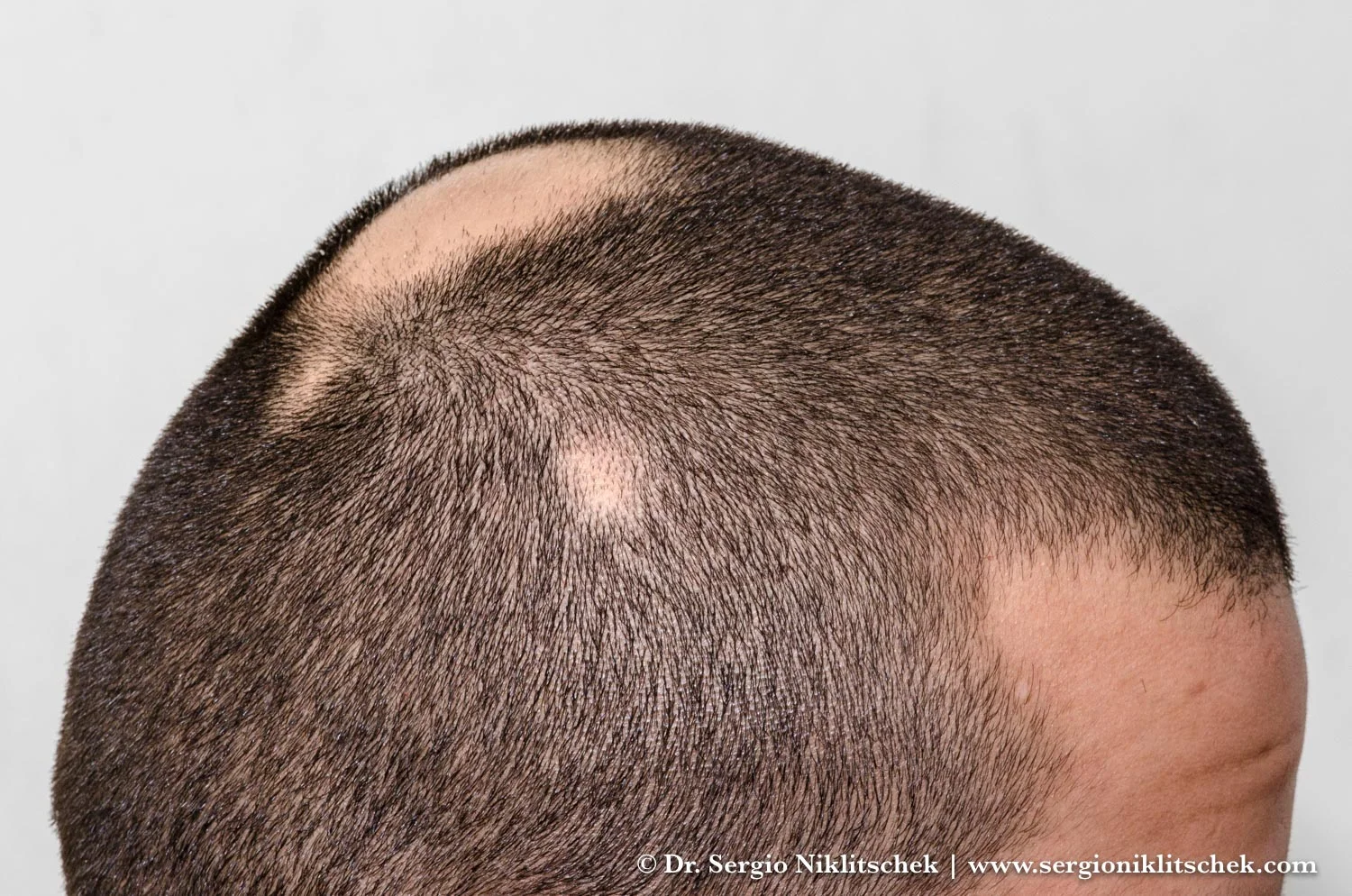 Alopecia areata