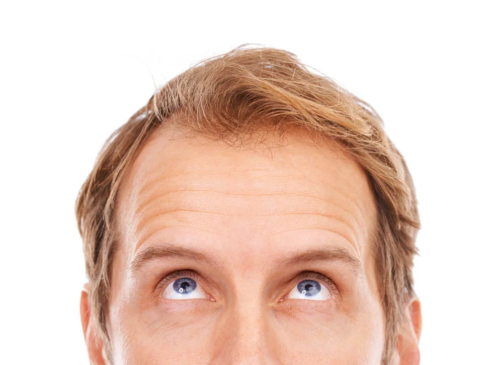 Alopecia.jpg