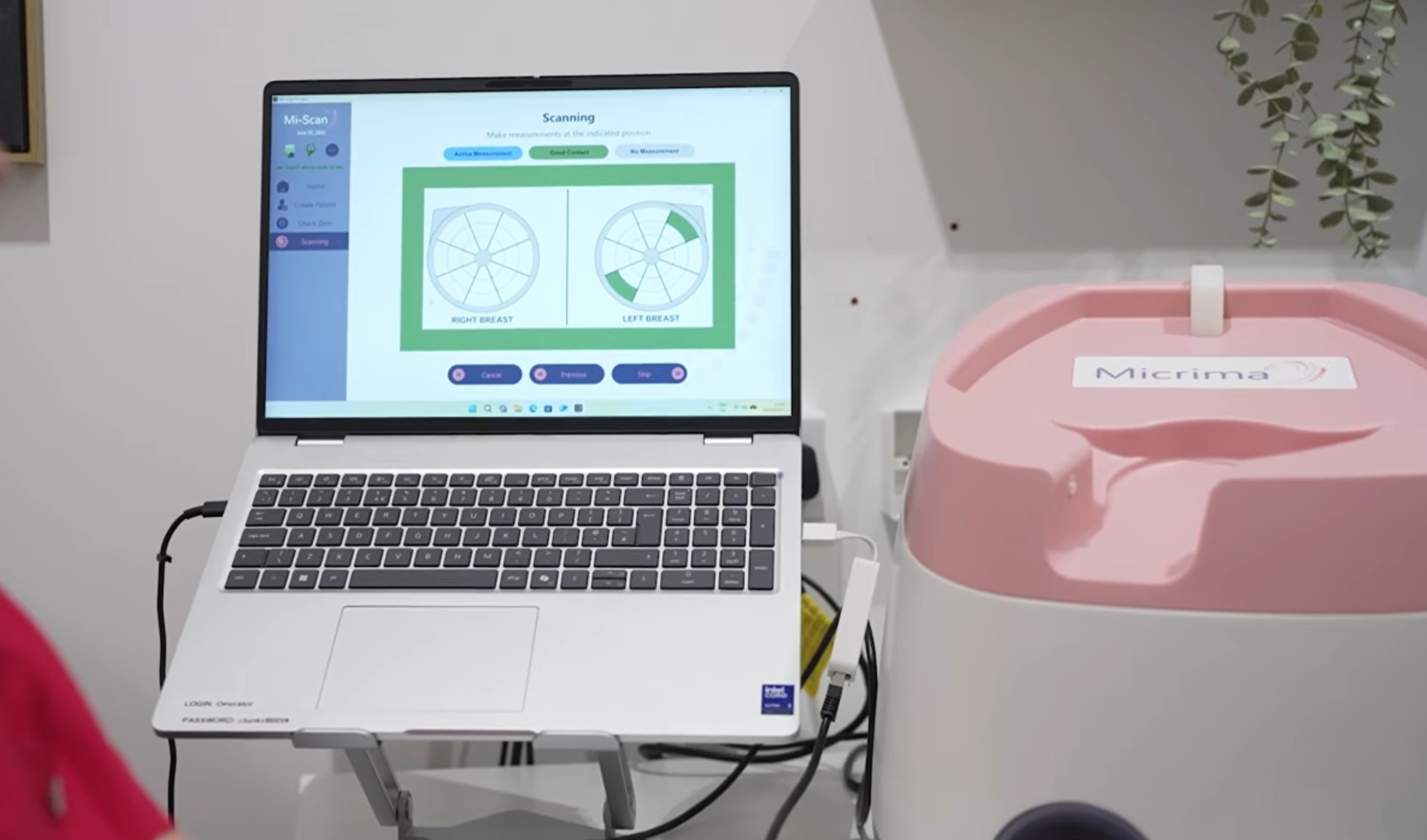 UK’s first breast density scanning clinic launches in Bristol to tackle hidden cancer risk indicator affecting millions
