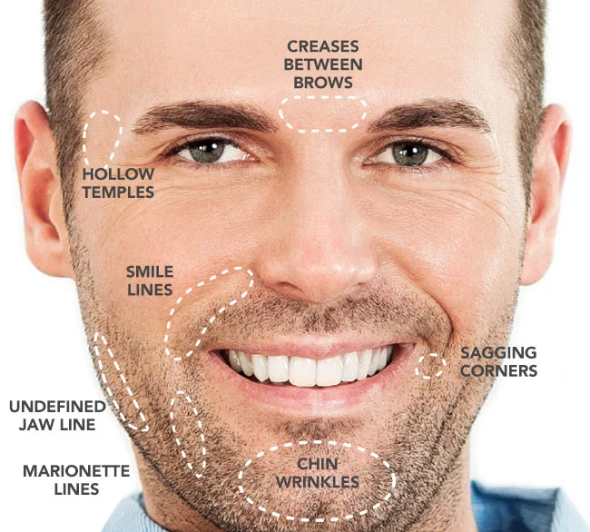 DERMAL FILLERS FOR MEN