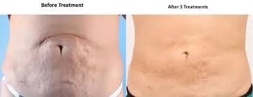  Single session non surgical body shaping