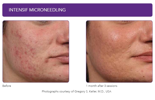 7--EndyMed-Intensif-Microneedling.jpg