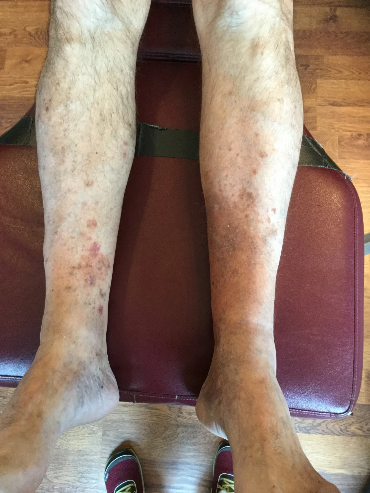 Seen this? Take a look at these legs. Have you seen anything similar in a client, patient or perhaps yourself? This gent came in with knee pain and we were looking at his feet. It turns out that this was a reaction to an antibiotic he had taken 3 years ago! Hyperpigmentation can be caused by bacterial infections, congenital problems, lime Cafe au Lait spots, endocrine disorders, like Addison’s disease and hyperthyroidism, hemochromatosis as well phototoxic reactions from the use of systemic or topical antibiotics (1, 2) or from contact with certain plants or foods in conjunction with sun exposure (3). Often initially, patients develop an reddened skin response caused by an allergic reaction. The inflammatory response often includes lymphocytes, eosinophils, and edema, which can result in a “blister like” reaction on sun-exposed skin. Over time, hyperkeratosis and melanocytic hyperplasia (increased numbers of the cells that give your skin pigmentation) develop, causing hyperpigmentation (1). Some medications result directly in hyperpigmentation, without sun exposure, in a diffuse pattern, like on the gent we see here (4-9). The tables included in reference 2 can provide additional clues Keep your eyes open! Who knows what the medications may have done to thwart your efforts in the healing response! Gould JW, Mercurio MG, Elmets CA. Cutaneous photosensitivity diseases induced by exogenous agents. J Am Acad Dermatol . 1995;33:551–73.
http://www.aafp.org/afp/2003/1115/p1955.html
Friedlander SF. Contact dermatitis. Pediatr Rev . 1998;19:166–71
Crowson AN, Magro CM. Recent advances in the pathology of cutaneous drug eruptions. Dermatol Clin . 1999;17:537–60.,viii
Pepine M, Flowers FP, Ramos-Caro FA. Extensive cutaneous hyperpigmentation caused by minocycline. J Am Acad Dermatol . 1993;28(2 pt 2):292–5.
Kelly AP. Aesthetic considerations in patients of color. Dermatol Clin . 1997;15:687–93.
Goroll AH, Mulley AG Jr, eds. Primary care medicine: office evaluation and management of the adult patient. 4th ed. Philadelphia: Lippincott Williams & Wilkins, 2000
Skin diseases of general importance—part II. In: Cecil RL, Goldman L, Bennett JC. Cecil Textbook of medicine. 21st ed. Philadelphia: Saunders, 2000: 2288–98
Friedlander SF. Contact dermatitis. Pediatr Rev . 1998;19:166–71.