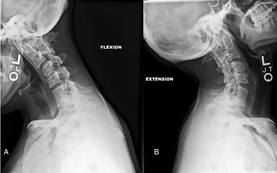 Treat the paraspinals in addition to the peripheral muscle As people who treat a wide variety of gait related disorders we often emphasize needling the paraspinal muscles associated with the segemental innervation of the peripheral muscle you are treating. For example, you may facilitate or needle the L2-L4 paraspinals (ie: femoral nerve distribution) along with the quads, or perhaps the C5-C6 PPD’s along with the shoulder muscles for the deltiods or rotator cuff for arm swiing. We do this to get more temporal and spacial summation at a spinal cord level, to hopefully get better clinical results. White and Panjabi described clinical instability as the loss of the ability of the spine, under physiologic loads, to maintain relationships between vertebrae in such a way that there is neither damage nor subsequent irritation to the spinal cord or nerve roots, and, in addition there is no development of incapacitating deformity or pain due to structural changes. Increased movement between vertebrae (antero or retrolisthesis) of > 3.5 mm (or 25% of the saggital body diameter) during flexion and/or extension suggests clinical instability. This often leads to intersegmental dysfunction and subsequent neurological sequelae which could be explained through the following mechanisms: Recall that the spinal nerve, formed from the union of the ventral (motor) and dorsal (sensory) rami, when exiting the IVF splits into an anterior and posterior division, supplying the structures anterior and posterior to the IVF respectively. The posterior division has 3 branches: a lateral branch that supplies the axial muscles such as the iliocostalis and quadratus; an intermediate branch, which innervates the medial muscles, such as the longissimus, spinalis and semispinalis; and a medial branch, which innervates the segmental muscles, (multifidus and rotatores) as well as the joint capsule. Inappropriate intersegmental motion has 2 probable neurological sequelae: I) alteration of afferentation from that level having segmental (reflexogenic muscle spasm or vasoconstrictive/vasodilatory changes from excitation of primary afferents and gamma motoneurons) and suprasegmental (less cerebellar afferentation, less cortical stimulation) effects and II) compression or traction of the medial branch of the PPD, causing, over time, demyelination and resultant denervation, of the intrinsic muscles, resulting in impaired motor control both segmentally and suprasegmentally. The segmental effects are directly measurable with needle EMG. This is a form of paraspinal mapping, which has also been explored by Haig et al. So, in short, instability can lead to denervation and denervation can lead to instability. We often see clinically that treating a trigger point (needling, dry needling, acupuncture, manual pressure) can alter the function of the associated muscle . Improvements in muscle strength and changes in proprioception are not uncommon. Needling also seems to increase fibroblastic activty through the local inflammation it causes. Wouldn’t better muscle function and some scar tissue be a beneficial thing to someone with instability? The next time you have a patient with instability, make sure to include the paraspinals in your quest for better outcomes.