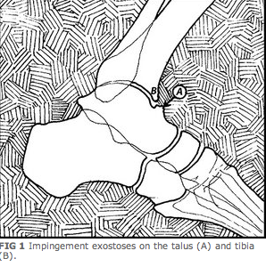 A great, quick read from one of our fav’s: Dr Tom Michaud. Here is my favorite excerpt. I had not thought of imaging the ankle quite this way “Physical examination reveals pinpoint sensitivity over the anteromedial capsule. When the ankle is slightly plantarflexed, the osteophytes on the talus and tibia can be readily palpated. Surprisingly, lateral X-rays only identify approximately 40 percent of the talotibial spurs, because the natural torsion of the distal tibia obstructs direct visualization of the anteromedial tibia. To improve radiographic accuracy, van Dijk, et al., recommend oblique radiographs be taken with a 45-degree craniocaudal angle, with the lower extremity externally rotated 30 degrees. The authors demonstrated that oblique radiographs identify 73 percent of the spurs located on the talus and 85 percent of the spurs located on the distal tibia.”
