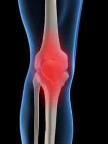 Folks with patellofemoarl pain move differently. But they don’t necessarily engage their trunk differntly. We think we all knew this, but here is a study that looks at it. “Compared with the control group, the PFP group demonstrated increased ipsilateral trunk lean, hip adduction and knee abduction (p = 0.02-0.04) during single-leg squat accompanied with decreased trunk isometric strength (p = < 0.001-0.009). There was no between-group difference in trunk muscle activation. Only in the control group, ipsilateral trunk lean was significantly correlated with hip adduction (r = -0.66) and knee abduction (r = 0.49); also, the side bridge test correlated with knee abduction (r = -0.51). Differences in trunk, hip and knee biomechanics were found in people with PFP. No relationship among trunk, hip and knee biomechanics was found in the PFP group, suggesting that people with PFP show different movement patterns compared to the control group.” Man Ther. 2015 Feb;20(1):189-93. doi: 10.1016/j.math.2014.08.013. Epub 2014 Sep 9.Trunk biomechanics and its association with hip and knee kinematics in patients with and without patellofemoral pain. Nakagawa TH 1 , Maciel CD 2 , Serrão FV 3 .