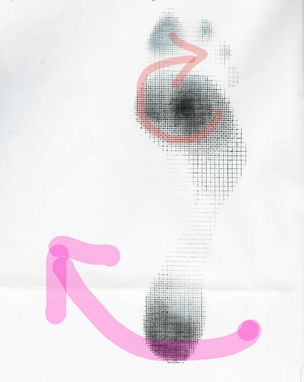 Abductory twist in your gait ? Last night on our www.onlinece.com teleseminar we discussed some clinical applications and critical thinking of gait parameters and pathology. We discussed the dynamic gait pedograph below. Possible evidence of Abductory Twist gait pathology (video link https://youtu.be/F3DHRoHrYOs ). In this case, client had loss of internal hip rotation, but they sure love external rotation pivot at the ground interface, as the pedo shows here (more details were provided on the teleseminar last night). *Fix the problem, retrain normal gait skills, add endurance and strength to the new gait pattern and you have a solution. Add an orthotic to treat what you see on the pedograph and you have a bandaid (and potentially/probably a problem down the road). You can’t fix a motor pattern compensation by forcing a compensatory fix. Get to the root of the problem, in this case hip and pelvic biomechanics ! It is all about mobility and stability !