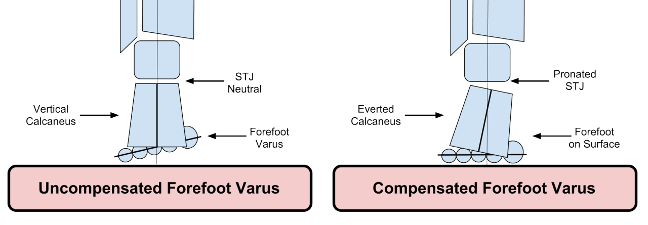 Varus Foot Rotation The Gait Guys