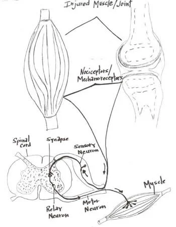 One way compensations develop
We have all had injuries; some acute some chronic. Often times injuries result in damage to the joint or articulation; when the ligament surrounding a joint becomes injured we call this a “sprain”.
Joints are blessed with four types of mechanoreceptors. We have covered this in many other posts (see here and here ). These mechanoreceptors apprise the central nervous system of the position (proprioception or kinesthesis) of that body part or joint via the dorsal column system or spinocerebellar tracts. Damage to these receptors can result in a mismatch or inaccuracy of information to the central nervous system (CNS). This can often result in further injury or a new compensation pattern.
Joints have another protective mechanism called arthrogenic inhibition (see diagram above). This protective reflex turns off the muscles which cross the joint. This was described in a few great paper by Iles and Stokes in the late 80’s an early 90’s (vide infra). Not only are the muscles inhibited, but it can also lead to muscle wasting; there does not need to be pain and a small joint effusion can cause the reflex to occur.
If the muscles are inhibited and cannot provide appropriate afferent (sensory) and efferent (motor) information to the CNS, your brain makes other arrangements to have the movement occur, often recruiting muscles that may not be the best choice for the job. We call this a “compensation” or “compensation pattern”. An example would be that if the glute max is inhibited (a 2 joint muscle, with a larger attachment to the IT band and a smaller to the gluteal tuberosity; it is a hip extender, external rotator and adductor of the thigh), you may use your lumbar erectors (multi joint muscles; extensors and lateral rotators of the lumbar spine) or hamstrings (2 joint muscles; hip extenders, knee flexors, internal and external rotators of the thigh) to extend the hip on that side, resulting in aberrant mechanics often observable in gait, which may manifest itself as a shortened step length, increased vertical displacement of the pelvis, lateral shift of the pelvis or increase in step height, just to name a few. Keep this up for a while and the new “pattern” becomes ingrained in the CNS and that becomes your new default for that motion.
Now to fix the problem, you not only need to reactivate the muscle, but you need to retrain the activity. Alas, the importance of doing a thorough exam and thorough rehab to fix the problem.
Often times, the fix is much more involved than figuring out what the problem is (or was). Take your time and do a good job. Your clients and patients will appreciate it!
Ivo and Shawn, the gait guys
Young A , Stokes M , Iles JF : Effects of joint pathology on muscle. Clin Orthop Relat Res. 1987 Jun;(219):21-7
Iles JF , Stokes M , Young A .: Reflex actions of knee joint afferents during contraction of the human quadriceps. Clin Physiol. 1990 Sep;10(5):489-500.
image from: http://chiroeco.com/chiro-blog/results-to-referrals/2013/04/03/neurology-based-simplified-musculoskeletal-assessment/