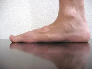 Some Fat on Flat Feet Normal feet:
more hindfoot dorsiflexion (read ankle rocker)
hindfoot more flexible
no or different compensation, if any
Symptomatic Flat feet:
less hindfoot dorsiflexion (read, reduced ankle rocker)
hindfoot was more everted, but less flexible.
forefoot compensates for reduced motion in rearfoot by increasing motion
hallux hypermobility
symptomatic flat feet lacked positive joint energy for propulsion
Asymptomatic flat feet:
less hindfoot dorsiflexion (read, reduced ankle rocker)
hindfoot was more everted, but less flexible.
forefoot compensates for reduced motion in rearfoot by increasing motion
hallux hypermobility
asymptomatic flat feet needed to absorb more negative ankle joint energy during loading response. This may risk fatigue and overuse syndrome of anterior shank muscles
“Hence, despite a lack of symptoms flatfoot deformity in asymptomatic flat feet affected function. Yet, contrary to what was expected, symptomatic flat feet did not show greater deviations in 3D foot kinematics than asymptomatic. Symptoms may rather depend on tissue wear and subjective pain thresholds.” http://www.ncbi.nlm.nih.gov/pubmed/23796513