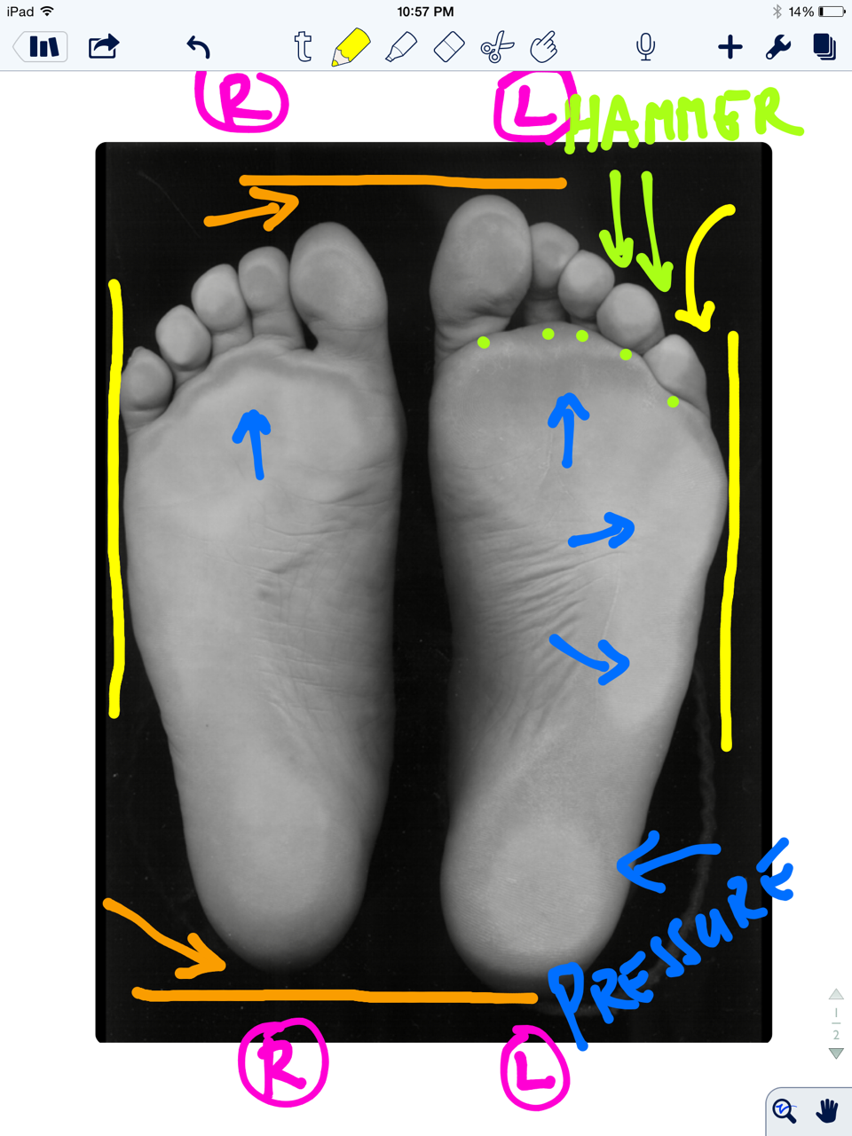 The “Standing on Glass” Static Foot/Pedograph Assessment: Part 1
* note: This is a static assessment dialogue. One cannot, and must not, make clinical decisions from a static assessment. As in all assessments, information is taken in, digested and them MUST be confirmed, denied and/or at the very least, folded into a functional and clinically relevant assessment of the client before the findings are accepted, dismissed and acted upon. As we always say, a gait analysis or pedograph-type assessment is never enough to make decisions on treatment to resolve problems and injuries. What is seen and represented on either are the client’s strategies around clinical problems or compensations. Today’s photo and blog post are an exercise in critical clinical thinking to get the juices flowing and to get the observer thinking about the client’s presentation and to help open up the field to questions the observer should be entertaining. The big questions should be, “why do i see this, what could be causing these observances ?”
* note the right and left sides by the R and L circled in pink.
ORANGE lines : The right foot appears to be shorter, or is it that the left is longer (see the lines and arrows drawing your attention to these differences)? A shorter foot could be represented by a supinated foot (if you raise the arch via the windlass mechanism you will shorten the foot distance between the rear and forefoot). A longer foot could be represented by a more pronated foot. Is that what we have here ? There is no way to know, this is a static presentation of a client standing on glass. What we should remember is that the goal is always to get the pelvis square and level. If an anatomically or functionally short leg is present, the short leg side MAY supinate to raise the mortise and somewhat lengthen the leg. In that same client, they may try to meet the process part way by pronating the other foot to functionally “shorten” that leg. Is that what is happening here ? So, does this client have a shorter right leg ? Longer left ? Do you see a plunking down heavily onto the right foot in gait ? Remember, what you see is their compensation. Perhaps the right foot is supinating, and thus working harder at the bottom end of the limb (via more supination), to make up for a weak right glute failing to eccentrically control the internal spin of the leg during stance phase ? OR, perhaps the left foot is pronating more to drive more internal rotation on the left limb because there is a restricted left internal hip rotation from the top ? Is the compensation top-down or bottom up ? These are all viable possibilities and you must have these things flowing freely through your head during the clinical examination as you rule in/rule out your hands-on findings. Remember, just going by a FMS-type screen to drive prescription exercises from what you see on a movement screen is not going to necessarily fix the problem, it could in fact lead one to drive a deeper compensation pattern. You can be sure that Gray Cook’s turbo charged brain is juggling all of these issues (and more !) when he sees a screen impairment, although we are not speaking for him here.
Remember this critical fact. After an injury or a long standing problem, muscles and motor patterns jobs are to stabilize and manage loads (stability and mobility) for adequate and necessary movement. Injuries leave a mark on the system as a whole because adaptation was necessary during the initial healing phase. This usually spills over during the early movement re-introduction phase, particularly if movement is reintroduced too early or too aggressively. Plasticity is the culprit. Just because the injury has come and gone does not mean that new patterns of skill, endurance, strength (S.E.S -our favorite mnemonic), stability and mobility were not subsequently built onto the apparently trivial remnants of the injury. There is nothing trivial if it is abnormal. The forces must, and will, play out somewhere in the body and this is often where pain or injury occurs but it is rarely where the underlying problem lives.
Come back tomorrow, where we will open your mind into the yellow, pink, blue and lime markings on the photo. Are the hammering toes (lime) on the left a clue ? How about the width of the feet (yellow) ? The posturing differences of the 5th toe to the lateral foot border ? What about the static plantar pressure differences from side to side (blue)? Maybe, just maybe, we can bring a logical clinical assumption together and then a few clinical exam methods to confirm or dis-confirm our working diagnostic assumption. See you tomorrow friends !
Shawn and ivo, the gait guys