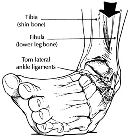 Functional Ankle Instability and the Peroneals
Lots of links available here with today’s blog post. please make sure to take your time and check out each one (underlined below)
As you remember, the peroneii (3 heads) are on the outside of the lower leg (in a nice, easy to remember order of longus, brevis and tertius, from top to bottom) and help to stabilize the lateral ankle . The peroneus brevis and tertius dorsiflex and evert the foot while the peroneus longus plantarflexes and everts the foot. We discuss the peroneii more in depth here in this post . It then is probably no surprise to you that people with ankle issues, probably have some degree of peroneal dysfunction. Over the years the literature has supported notable peroneal dysfunction following even a single inversion sprain event.
Functional ankle instability (FAI) is defined as “ the subjective feeling of ankle instability or recurrent, symptomatic ankle sprains (or both) due to proprioceptive and neuromuscular deficits."
Arthrogenic muscle inhibition (AMI) is a neurological phenomenon where the muscles crossing a joint become "inhibited”, sometimes due to effusion (swelling) of the joint (as seen here ) and that may or may not be the case with the ankle (see here ), or it could be due to nociceptive input altering spindle output or possibly higher centers causing the decreased muscle activity.
This paper (see abstract below) merely exemplifies both the peroneals and FAI as well as AMI.
Take home message?
Keep the peroneals strong with lots of balance work!
The Gait Guys: bringing you the meat, without the filler!
Am J Sports Med. 2009 May;37(5):982-8. doi: 10.1177/0363546508330147. Epub 2009 Mar 6.
Peroneal activation deficits in persons with functional ankle instability.
Palmieri-Smith RM , Hopkins JT , Brown TN .
Source
School of Kinesiology, University of Michigan, 401 Washtenaw Avenue, Ann Arbor, MI 48109, USA. riannp@umich.edu
Abstract
BACKGROUND:
Functional ankle instability (FAI) may be prevalent in as many as 40% of patients after acute lateral ankle sprain. Altered afference resulting from damaged mechanoreceptors after an ankle sprain may lead to reflex inhibition of surrounding joint musculature. This activation deficit, referred to as arthrogenic muscle inhibition (AMI), may be the underlying cause of FAI. Incomplete activation could prevent adequate control of the ankle joint, leading to repeated episodes of instability.
HYPOTHESIS:
Arthrogenic muscle inhibition is present in the peroneal musculature of functionally unstable ankles and is related to dynamic peroneal muscle activity.
STUDY DESIGN:
Cross-sectional study; Level of evidence, 3.
METHODS:
Twenty-one (18 female, 3 male) patients with unilateral FAI and 21 (18 female, 3 male) uninjured, matched controls participated in this study. Peroneal maximum H-reflexes and M-waves were recorded bilaterally to establish the presence or absence of AMI, while electromyography (EMG) recorded as patients underwent a sudden ankle inversion perturbation during walking was used to quantify dynamic activation. The H:M ratio and average EMG amplitudes were calculated and used in data analyses. Two-way analyses of variance were used to compare limbs and groups. A regression analysis was conducted to examine the association between the H:M ratio and the EMG amplitudes.
RESULTS:
The FAI patients had larger peroneal H:M ratios in their nonpathological ankle (0.399 +/- 0.185) than in their pathological ankle (0.323 +/- 0.161) (P = .036), while no differences were noted between the ankles of the controls (0.442 +/- 0.176 and 0.425 +/- 0.180). The FAI patients also exhibited lower EMG after inversion perturbation in their pathological ankle (1.7 +/- 1.3) than in their uninjured ankle (EMG, 3.3 +/- 3.1) (P < .001), while no differences between legs were noted for controls (P > .05). No significant relationship was found between the peroneal H:M ratio and peroneal EMG (P > .05).
CONCLUSION:
Arthrogenic muscle inhibition is present in the peroneal musculature of persons with FAI but is not related to dynamic muscle activation as measured by peroneal EMG amplitude. Reversing AMI may not assist in protecting the ankle from further episodes of instability; however dynamic muscle activation (as measured by peroneal EMG amplitude) should be restored to maximize ankle stabilization. Dynamic peroneal activity is impaired in functionally unstable ankles, which may contribute to recurrent joint instability and may leave the ankle vulnerable to injurious loads.
all material (except for the study); copyright 2013 The Gait Guys/ The Homunculus Group. All rights reserved. Please ask before you lift our stuff. If you are nice and give us credit, we will probably let you use it!