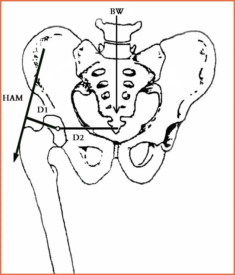 Hip Biomechanics Part 2
Figure 1 shows the condensed version of the parameters (forces and moment arms) affecting movement and stability of the femur-acetabulum complex in the frontal plane during the closed kinetic chain. (A moment arm such as D1 and D2 is defined as the length of a line that extends from the axis of rotation to a point of right angle intersection with a respective force, in this case HAM or BW.)
In Figure 1 above we see several parameters. HAM represents the Hip Abductor Muscles, D1 represents the internal moment arm, D2 represents the external moment arm and BW represents the Body Weight of the individual. These factors all come into play when considering the frontal plane equilibrium of the hip joint. The equation representing the interaction of all of these parameters is HAM x D1 = D2 x BW. Both sides of this equation must be equal and balanced in order for the pelvis to remain stable and without movement when in the closed chain stance phase of gait. In this diagram, if the left side of the equation is greater than the right the net effect will be a counterclockwise hip moment and the patient will move their torso over the hip creating a hiking or lifting of the contralateral hip. This net movement will create abduction at the hip joint. If the right side of the equation is greater than the left the net effect will be a clockwise hip moment and the patient will move their torso away from the hip creating a dropping of the contralateral hip. This net movement will create adduction at the hip joint seen here and thus the classic Trendelenberg gait. We need to keep in mind that this is not a perfect model presented here since we are ignoring acceleration of the body in the forward sagittal plane and rotational planes. Investigating the equation further should bring the reader to further realization that if the body weight (BW) were to increase, mathematically the D2 external moment arm could decrease to keep the equation balanced. However, since the length of this D2 moment arm is rather fixed (unless the pelvis were to go through a counterclockwise rotation which would draw the body weight center closer to the hip joint center effectually abducting the stance hip, thus reducing the D2 moment arm) this is not a more likely scenario. Rather, the response would be to attempt to increase the left side of the mathematical equation thus increasing the HAM forces to attempt to keep the pelvis level and the equation from changing. In other words, when body weight increases we must increase the gain or contraction in the HAM group during each step to keep the pelvis level and balanced. Unfortunately the HAM strength has its limits of maximal contraction, sometimes far below any major increases in body weight. One must keep in mind that with increased HAM contraction there is a corresponding increase in joint compression across the hip articular surfaces which at reasonable levels is well embraced but at unreasonable levels can damage articular cartilage. One should thus conclude that maintaining a reasonable body weight for one’s bone structure keeps the right and left sides of the mathematical equation at tolerable levels, both for movement, stability and cartilage longevity. Fortunately the equation has a built in safety mechanism for these counterclockwise hip moments, one that is beneficial. In such scenarios, as the body is brought over the hip thus decreasing the D2 moment arm, the D1-internal moment arm increases in length and since the equation must be balanced the HAM force can decrease. Thus, the magnitude of the HAM force is inversely proportional to the length of the D1-internal moment arm. The whole equation can better be visualized and conceptualized by a teeter totter diagram with a sliding pivot point.
Shawn and Ivo, The Gait (and biomechanics) Guys