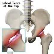 Got Hip Pain ? Attention Runners and Athletes with Hip Pain.
Compensatory joint motions are quite often a source of a person’s pain. Shirley Sahrmann named her hip syndromes for the direction of the movement most consistently associated with pain. In a recent CME presentation we did for www.onlineCE.com we discussed the accessory movements found with the hip.
Lets look at the known normal biomechanical facts:
During hip flexion the accessory motion is posterior glide of the femoral head.
Hip extension: accessory motion is anterior glide of the femoral head.
Hip medial (internal) rotation: accessory motion is posterior glide of the femoral head.
Hip lateral (external) rotation: accessory motion is anterior glide of the femoral head.
Hip abduction: accessory motion is inferior glide of the femoral head.
Hip adduction: accessory motion is superior glide.
Impairment, either from joint/bony deformation (ie. torsions) or from functional muscular asymmetry, can lead to impairment of the accessory motions (compensation) that are necessary for clean joint function. This can lead to pain.
For you clinicians out there, knowing your hip torsions and versions will impact the amount/degree of these accessory motions. This is why we harp on knowing your fixed anatomic variants. (You can find discussions on these in our prior blog posts and on previous recorded www.onlineCE.com teleseminar presentations.) For example, reduced medial rotation at the hip (usually met with increased external rotation) is often seen in people with retrotorsion of the femur. Said another way, when your client has impaired medial or lateral hip rotation you must go beyond looking at the muscles at some point and consider whether they have a form of ante or retro torsion.
Hip extension is a critical part of normal human ambulation, whether you are walking or running. Normally the hip, when moving into extension during the final propulsive phase of ambulation, allows for the femoral head of the hip to glide anterior in the socket (acetabulum). This reduces labral RIM pinch (RIM Syndromes) and allows for greater safe extension range. If hip extension range is impaired then this accessory motion of anterior glide can be impaired and lead to compensation and pain.
Think about this:
What if the quadriceps are tight ?
What If the Glutes are weak ?
What if rotational muscles are short ?
What if ankle rocker (dorsiflexion) is impaired ?
What if there is neuro-inhibition from joint pain (ie. osteoarthritis or joint mal-centration etc) ?
What if there is imbalance and weaknesses about the hip ?
What if there are other faulty movement patterns ?
What if there is one of the femoral torsions present ?
Much of this is “chicken or the egg”, who came first ? These “what ifs” are what make practicing medicine difficult and a real challenge. Some of these issues can be found during functional movement assessments, but some of them will be missed if that is all you are doing. These issues may be what separates the good clinician, therapist, coach or trainer from the “not so good”. Knowing if a person has an impaired rolling pattern (see here http://youtu.be/dqnR0EcW2YY ) is great to know, but knowing if the lower limb driver is off because the hip cannot internally rotate is even greater. Merely giving the person the homework of practicing and repeating the rolls on the impaired driver side without assessing all of the parts (for example some of the issues above) may cause you to miss the boat, or to engrain a new faulty motor pattern.
Knowledge is prince, application of knowledge is king.
Next week we will begin a blog post a week on the biomechanics of the hip. We hope you will join us.
Shawn and Ivo
Here are some of our prior blog posts to add and deepen this dialogue:
http://thegaitguys.tumblr.com/post/7493909435/the-hip-part-1-hip-labral-tears-the-rim-syndromes
http://thegaitguys.tumblr.com/post/7533986761/ars-acetabular-rim-syndromes-hip-pain-some
http://thegaitguys.tumblr.com/post/7573791535/the-hip-part-3-more-on-hip-rim-syndromes-and-labral
