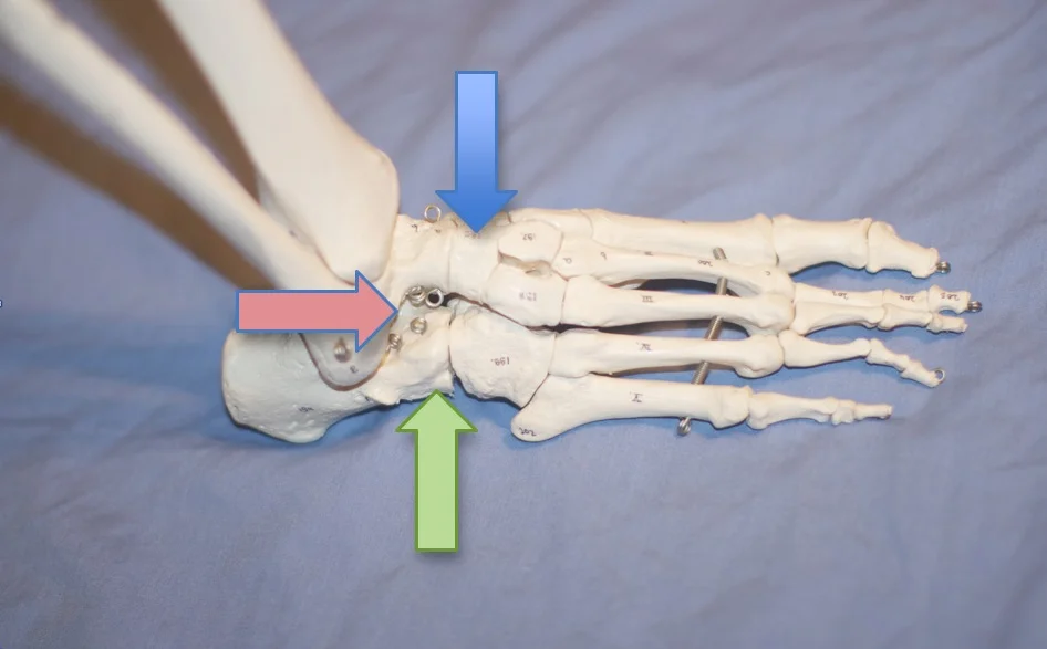 image from: http://www.aofas.org/footcaremd/treatments/pages/triple-arthrodesis.aspx