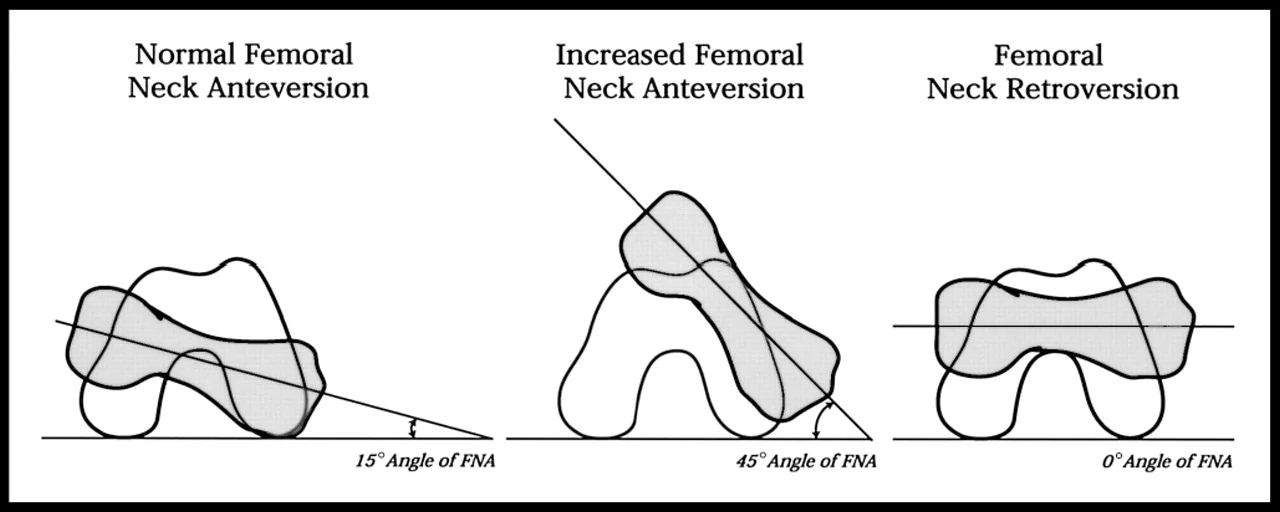 IMAGE SOURCE: Michael T Cibulka; Determination and Significance of Femoral Neck Anteversion, Physical Therapy , Volume 84, Issue 6, 1 June 2004, Pages 550–558, https://doi.org/10.1093/ptj/84.6.550