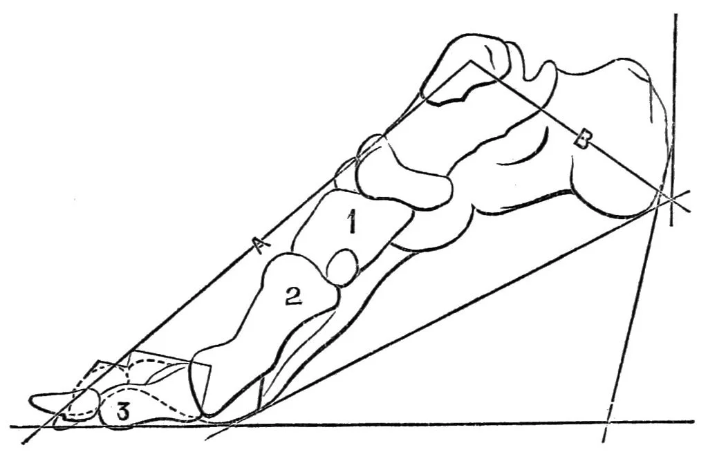 PSM_V24_D673_Deforming_pressure_of_high_heels_on_the_foot_bone_structure.jpg