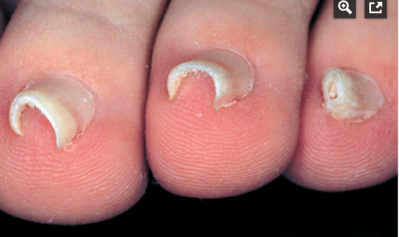 Pincer nail of great toe sparing smaller digits. | Open-i