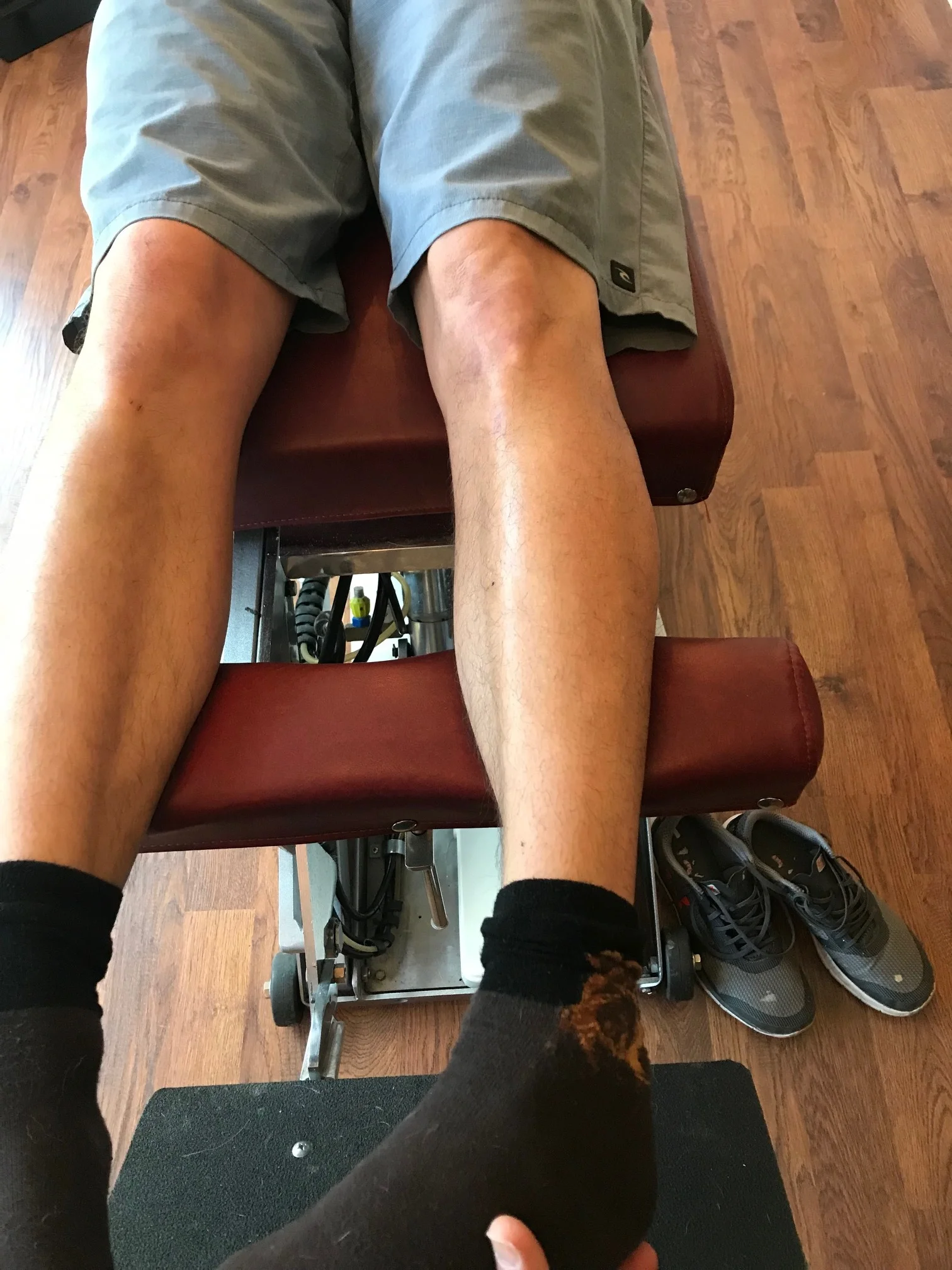 note the internal tibial torsion. drop a plumbline from the tibial tuberosity. it should pass through the 2nd met or between the 2nd and 3rd met shafts