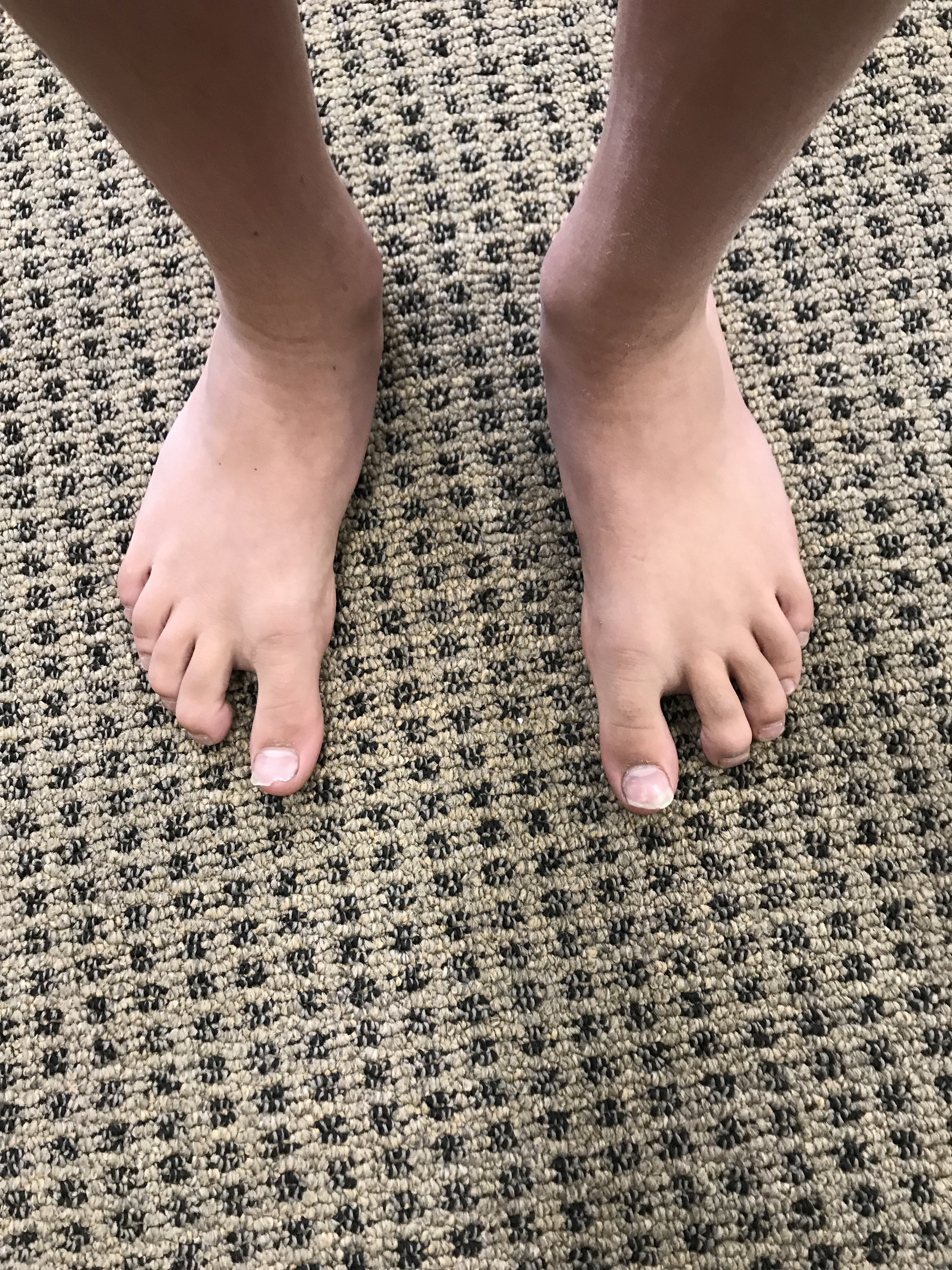 sandal toe