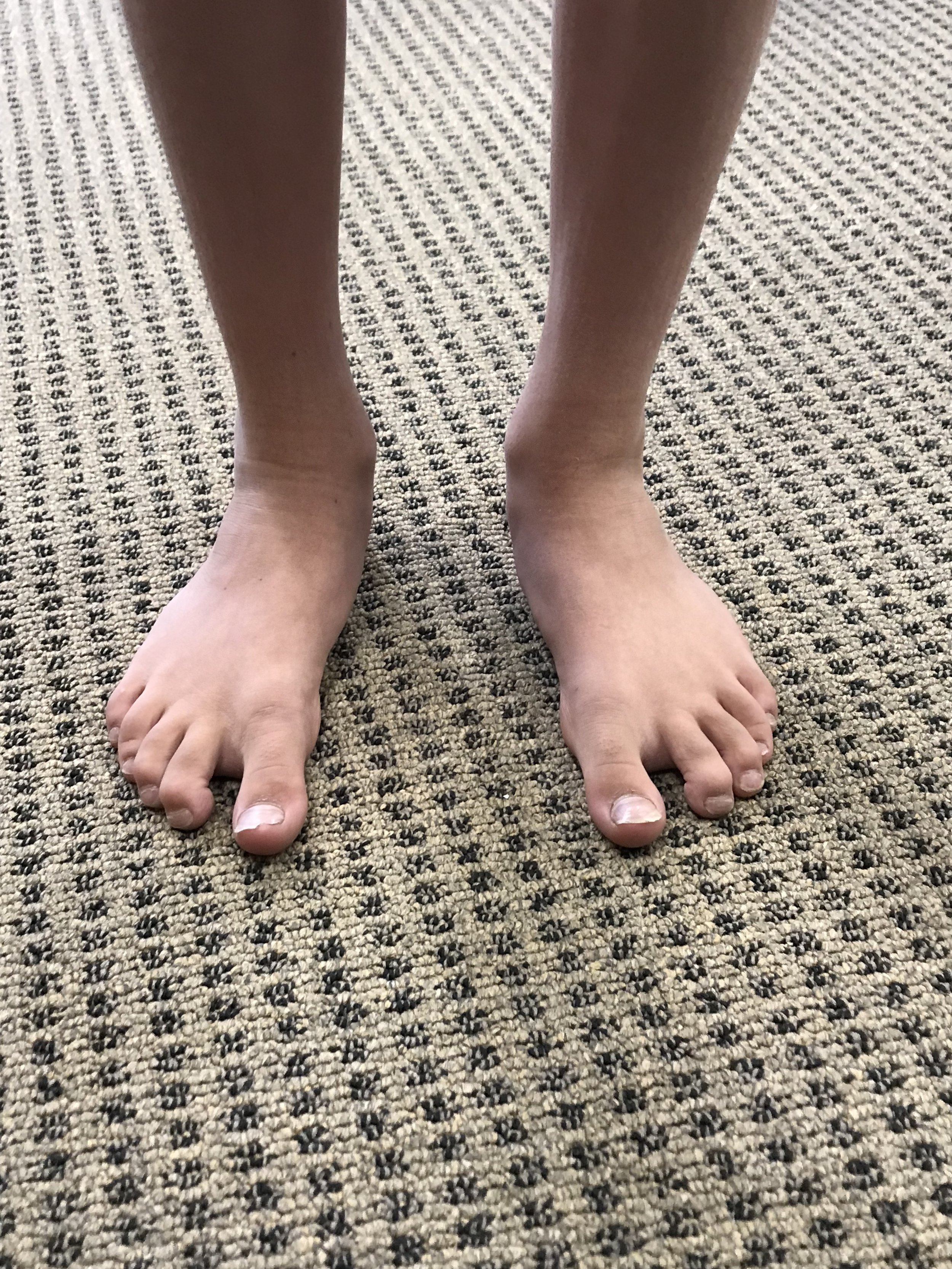 sandal toe