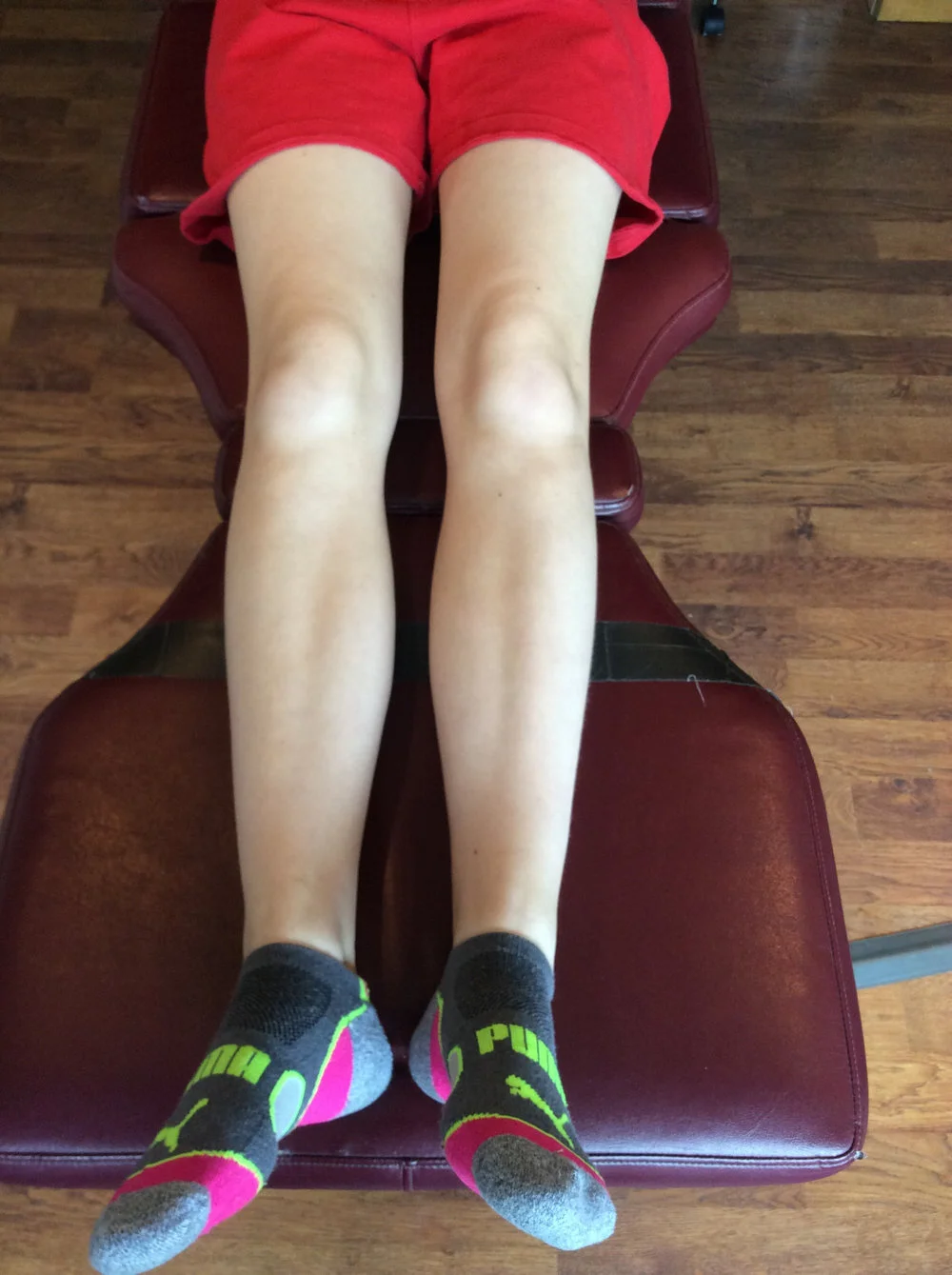 knees neutral, note external rotation of the right foot and decreased progression angle