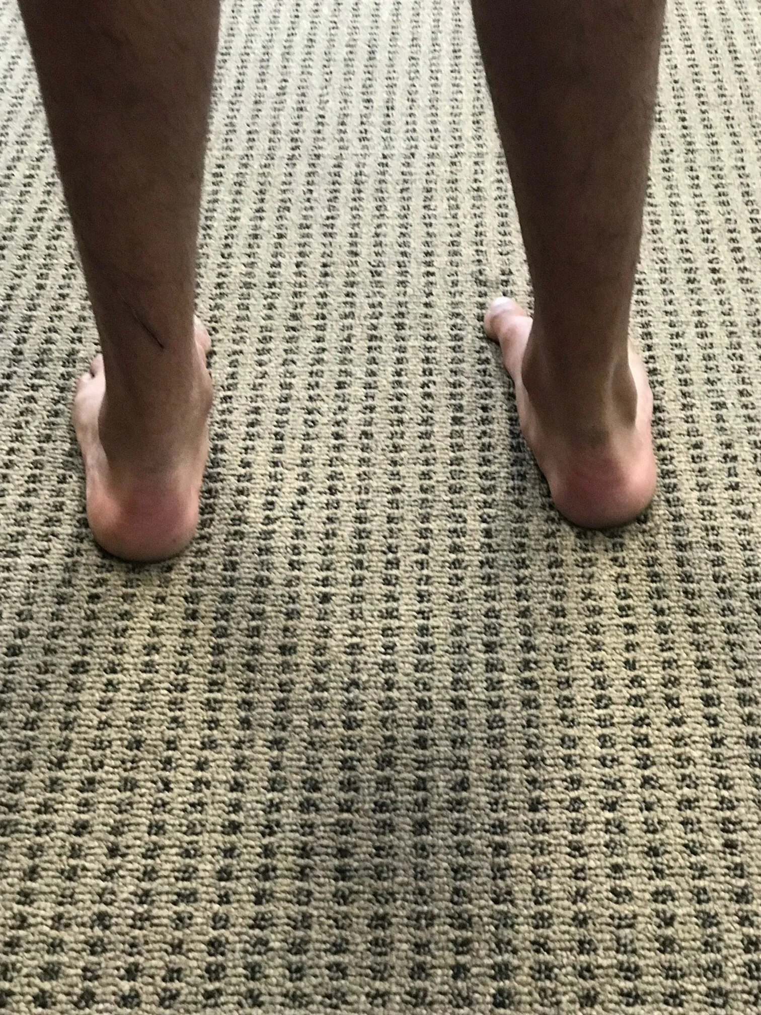 right calcaneal valgus