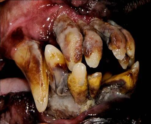 Severe periodontal disease