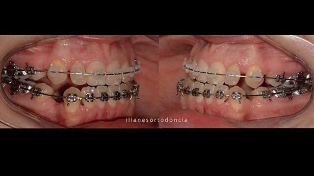 Este es un post en respuesta a uno que anda circulando por ah&iacute; 😉. 1. La ortodoncia no se trata de sentido com&uacute;n. 2. La ortodoncia es una ciencia y hay que buscar las respuestas en ella. 
3. No hay que pensar que el hueso es una estruct