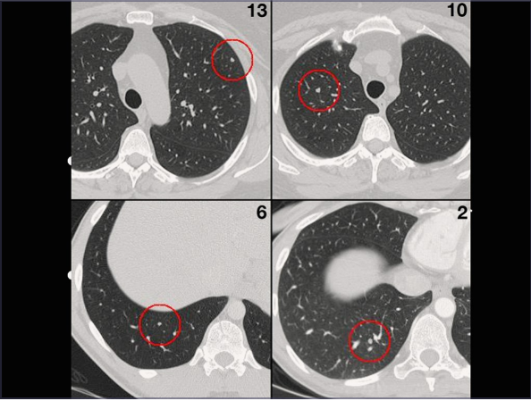 mesothelioma blogs uk