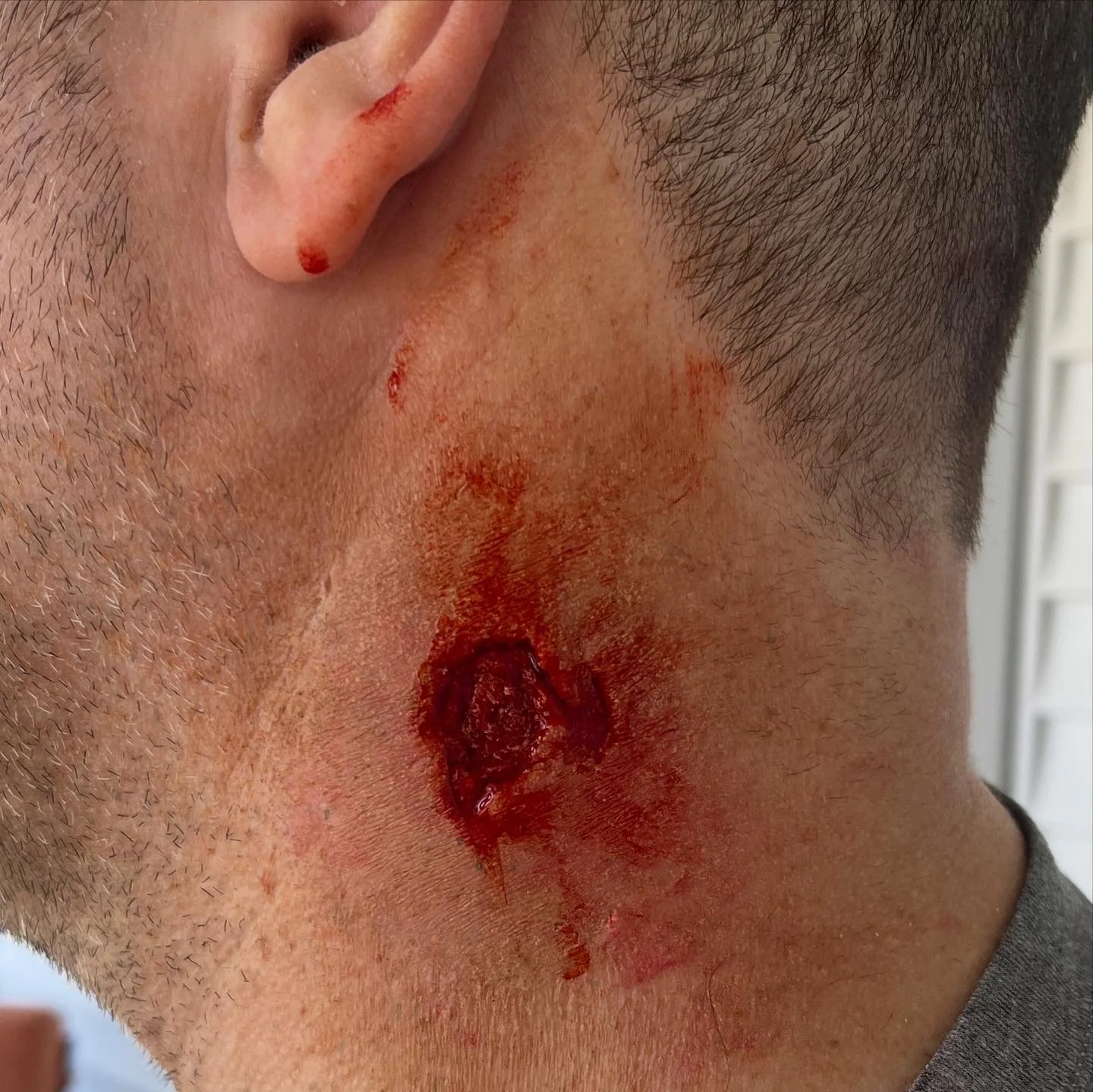 Trauma-Silicone encapsulated prosthetic piece with super baldiez 