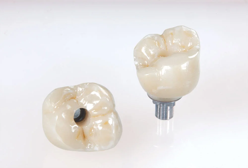im0101-inclusive-abutment-bruxzir-crown-02.jpg