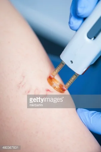 Is laser treatment safe?