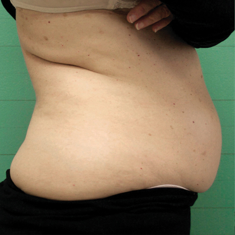 FAT REDUCTION before.jpg