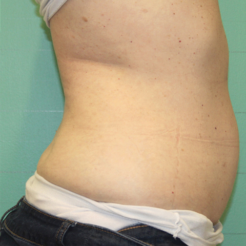 FAT REDUCTION afterjpg.jpg