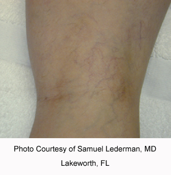 Leg vein after 1 treatment.jpg
