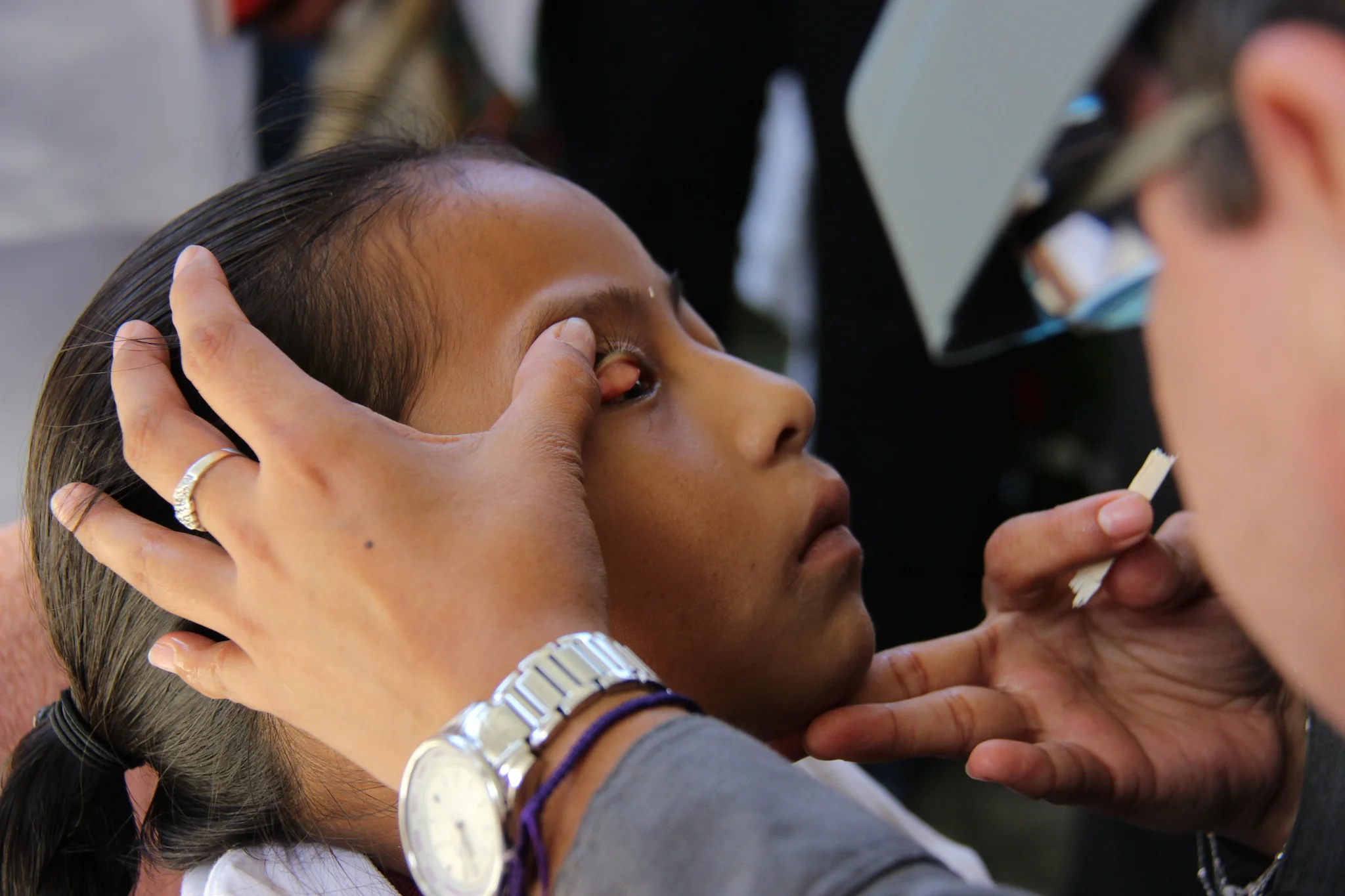 Treating trachoma