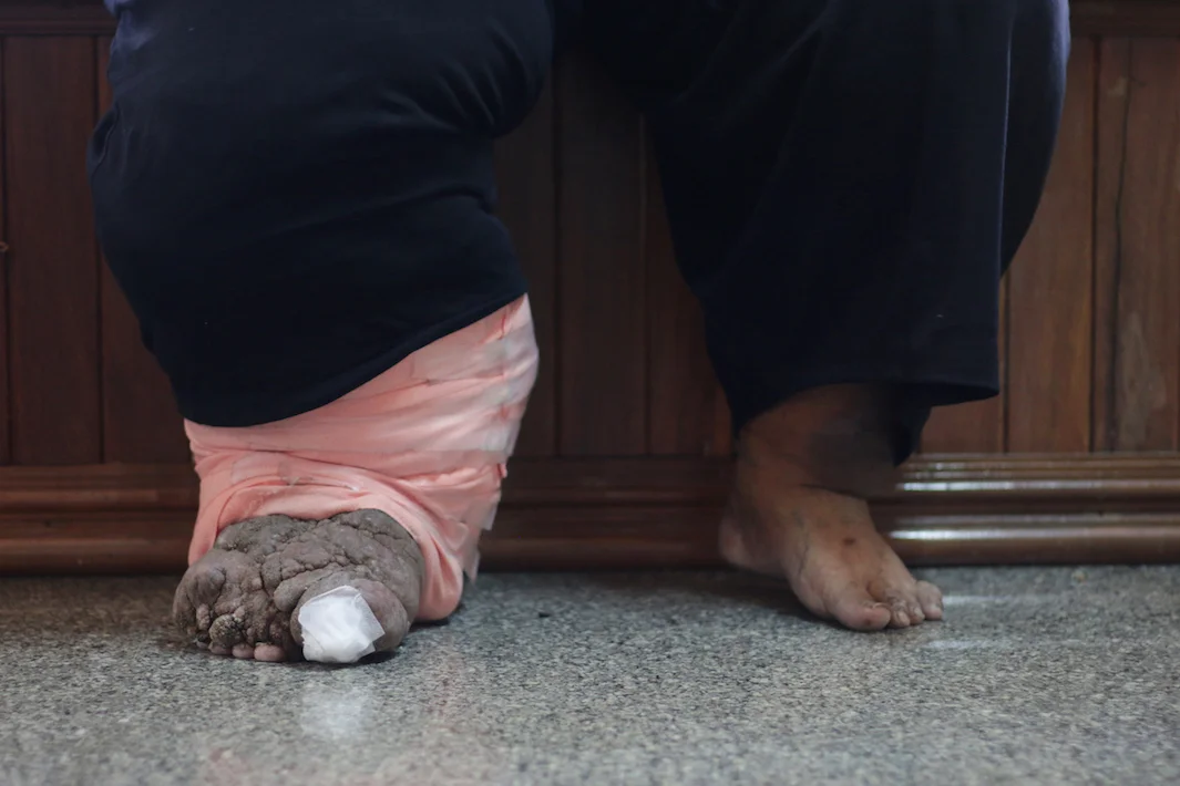 A case of lymphatic filariasis. photo: MintZaa/shutterstock