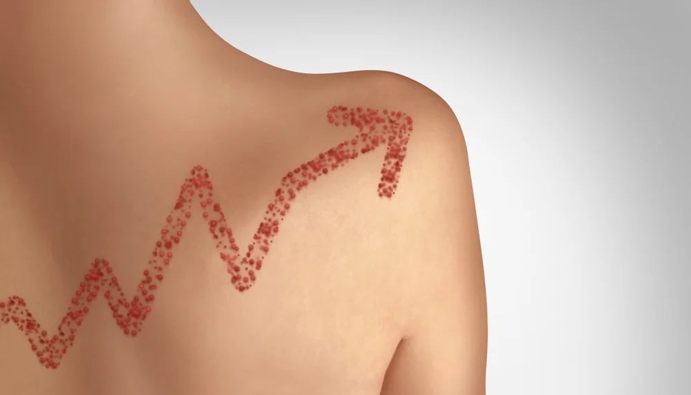 Measles outbreaks have been on the rise. Lightspring/shutterstock